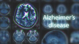 Alzheimer’s Disease Veterans Benefits