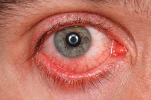 Chronic Conjunctivitis Veterans Benefits