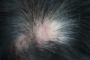Scarring Alopecia Veterans Benefits